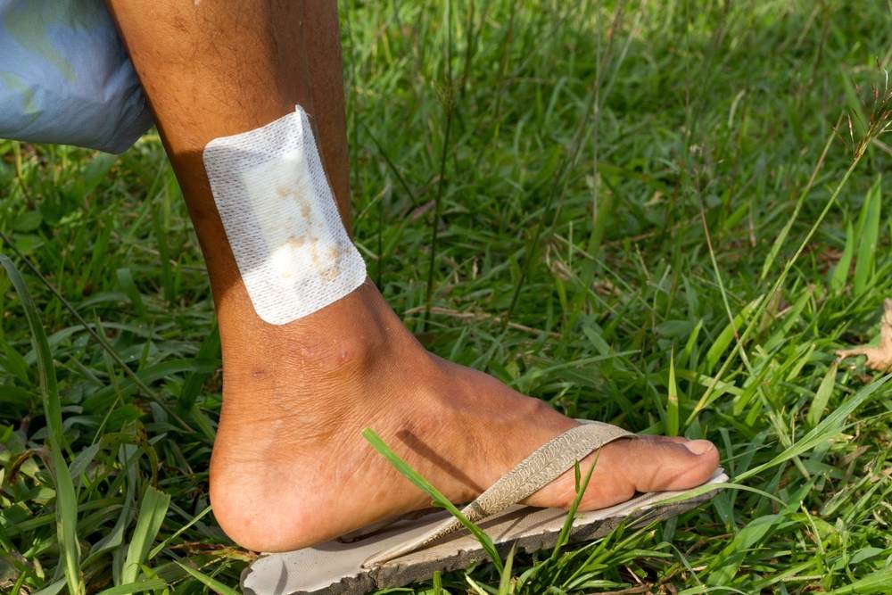 Person with a bandaged ankle injury standing on grass representing the type of serious injury caused by a negligent property owner in Wisconsin