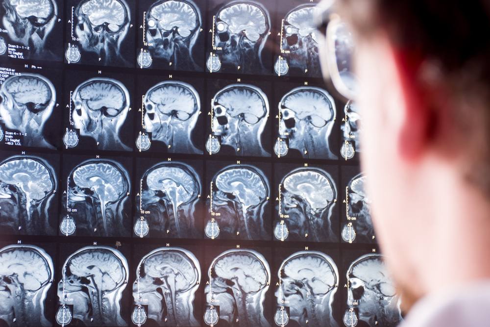 Doctor examining a series of brain MRI scans used to document a traumatic brain injury claim in Wisconsin